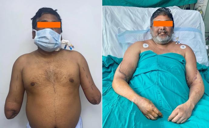 印度男画家移植双臂