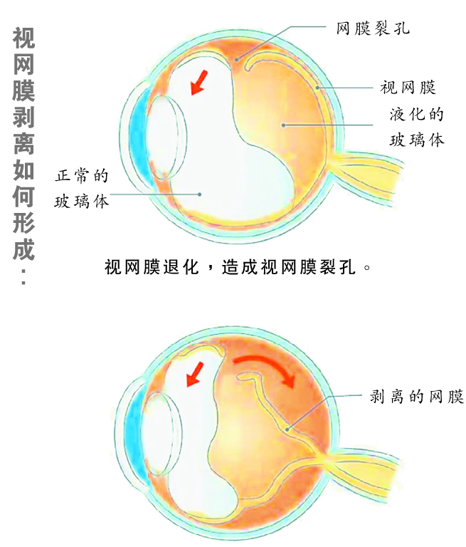 玻璃体液灌入裂孔到视网膜，就形成视网膜剥离。