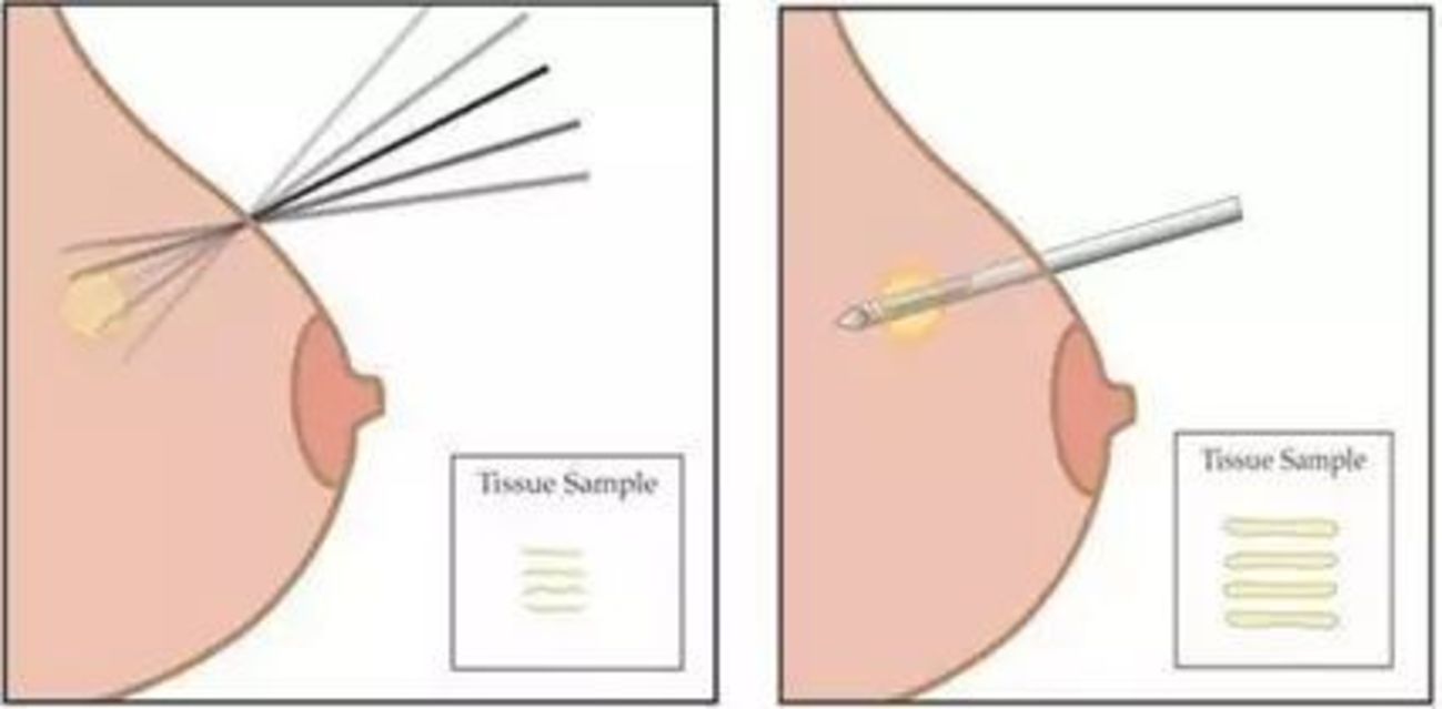 活检有两种方法：穿刺针活检和手术活检。