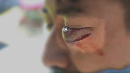 在香港观塘区反智能街灯示威期间，一名示威者疑被海绵弹或橡皮弹击中左眼，致下眼睑高高肿起