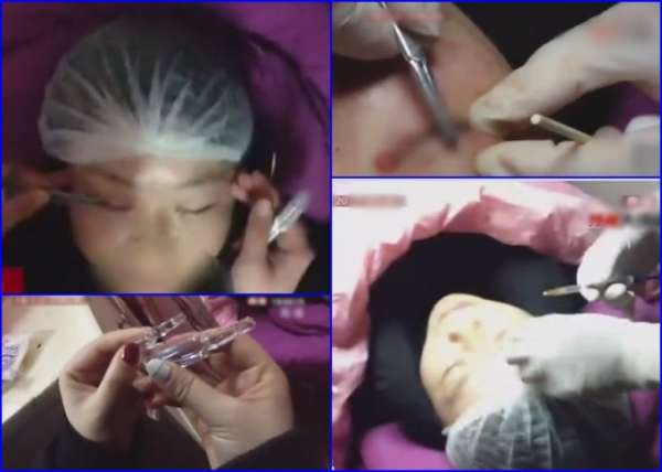 接受双眼皮埋线手术的女客不时喊痛。（电视画面）