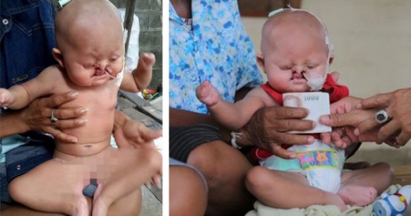 泰国一名畸形婴儿患美人鱼综合症，身世可怜。