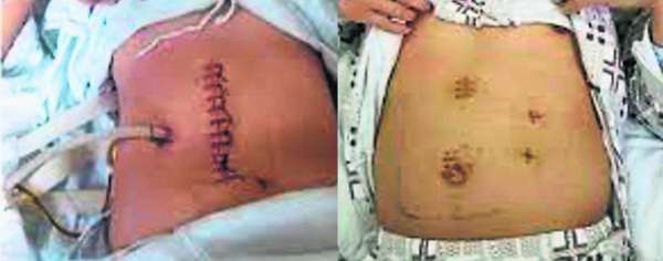 左图为传统脾脏切除术留下的“大长疤”；右图为微创脾脏切除术留下的“小不点”。