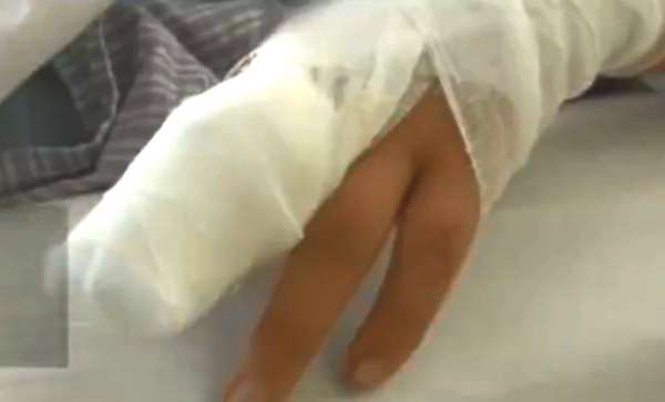 黑龙江女童因祖母乱用偏方导致手指截肢。（网上照片）