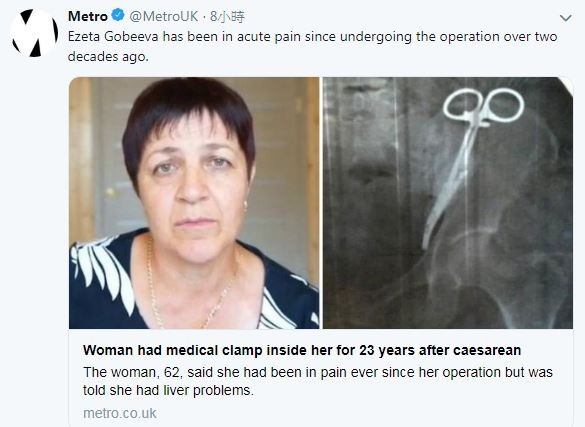 62岁的戈比娃多年来腹部频繁剧痛，检查后发现原来是一把手术钳在腹中。（翻摄自推特）