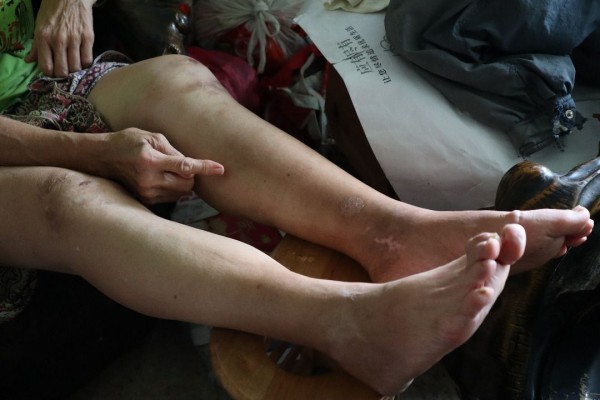 郑钰蓉声称遭一名部长的车碾过双脚，伤势至今仍未复原。